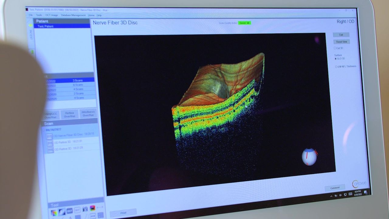 nerve fiber 3d at Alberta Eye Care